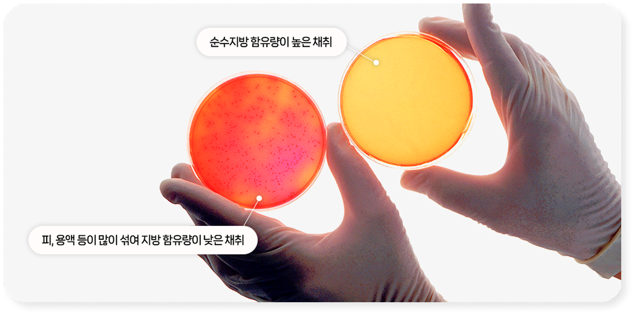 심부볼 지방제거 4