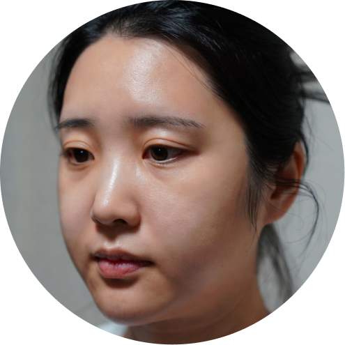 심부볼 지방제거 추천 시술 2