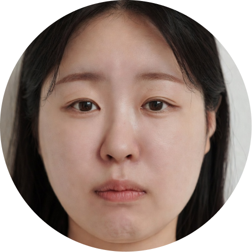 심부볼 지방제거 추천 시술 3