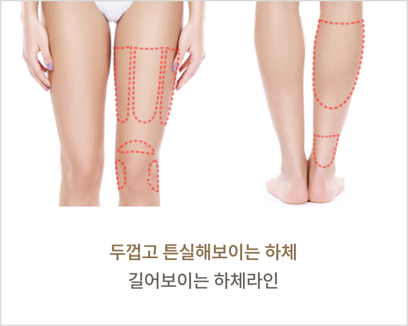 지방 분해 주사 부위별 맞춤 디자인 3