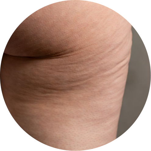 지방 분해 주사 추천 시술 3